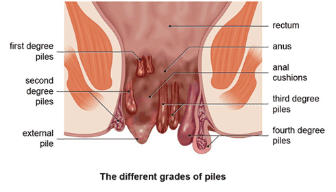 Haemorrhoids Piles Rana Piles Hospital