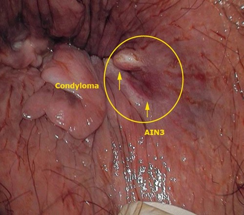 Internal Anal Warts - Small lumps inside anus - Porn Images