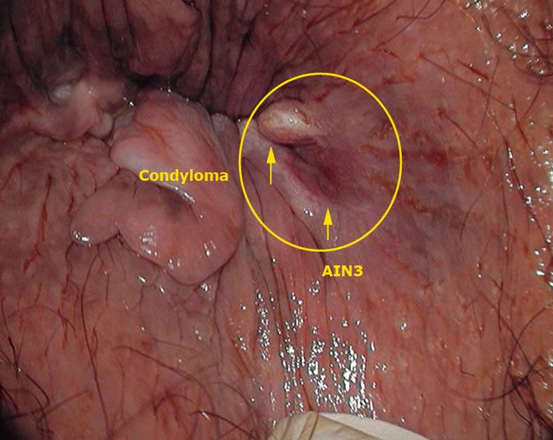 Human Papillomavirus, Condylomata Acuminata, and Anal ...