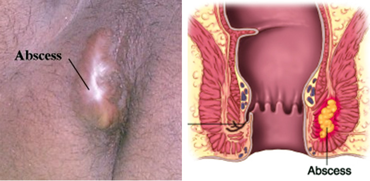 Abscess: Causes, Symptoms, Tests, and Treatment