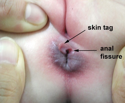 Rectal Anal 49