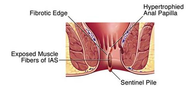 Perianal skin tag removal recovery