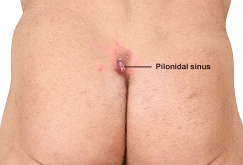 Pilonidal Disease