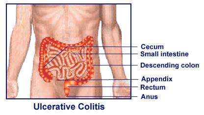 Ulcerative-Colitis-1
