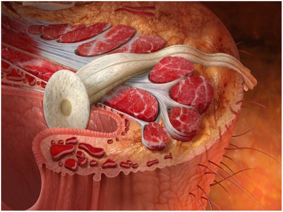 Fistula